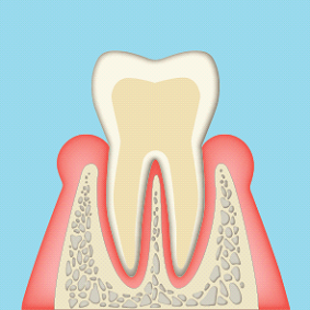 歯周炎