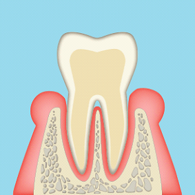 軽度歯周病