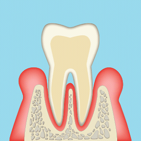中度歯周病